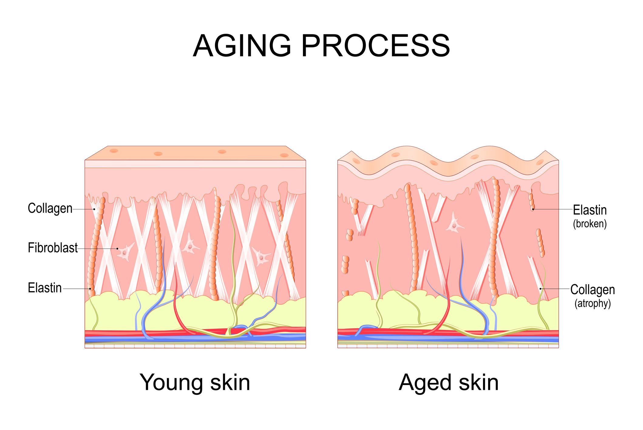 Starnutie kože - znázorňuje postupné poruchy kolagénu, fibroblastov a elastínu
