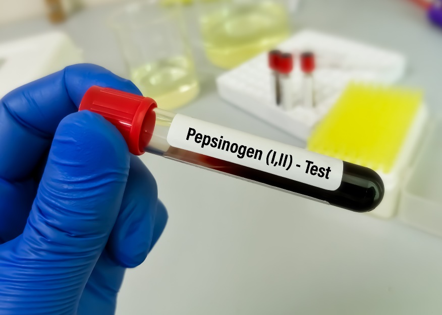 Krvná vzorka pre laboratórny test na hladinu pepsinogenu a gastro ochorenia