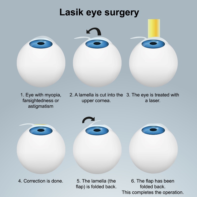 LASIK laserová operácia očí – podpovrchová metóda. Priebeh zákroku s príklopkou/ flapom bez poškodenia nervového zakončenia.