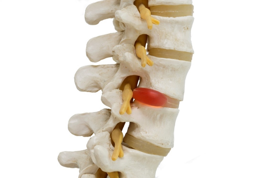 Anatomické znázornenie 3D model chrbtice, medzistavcových platničiek a hernie disku s útlakom nervu
