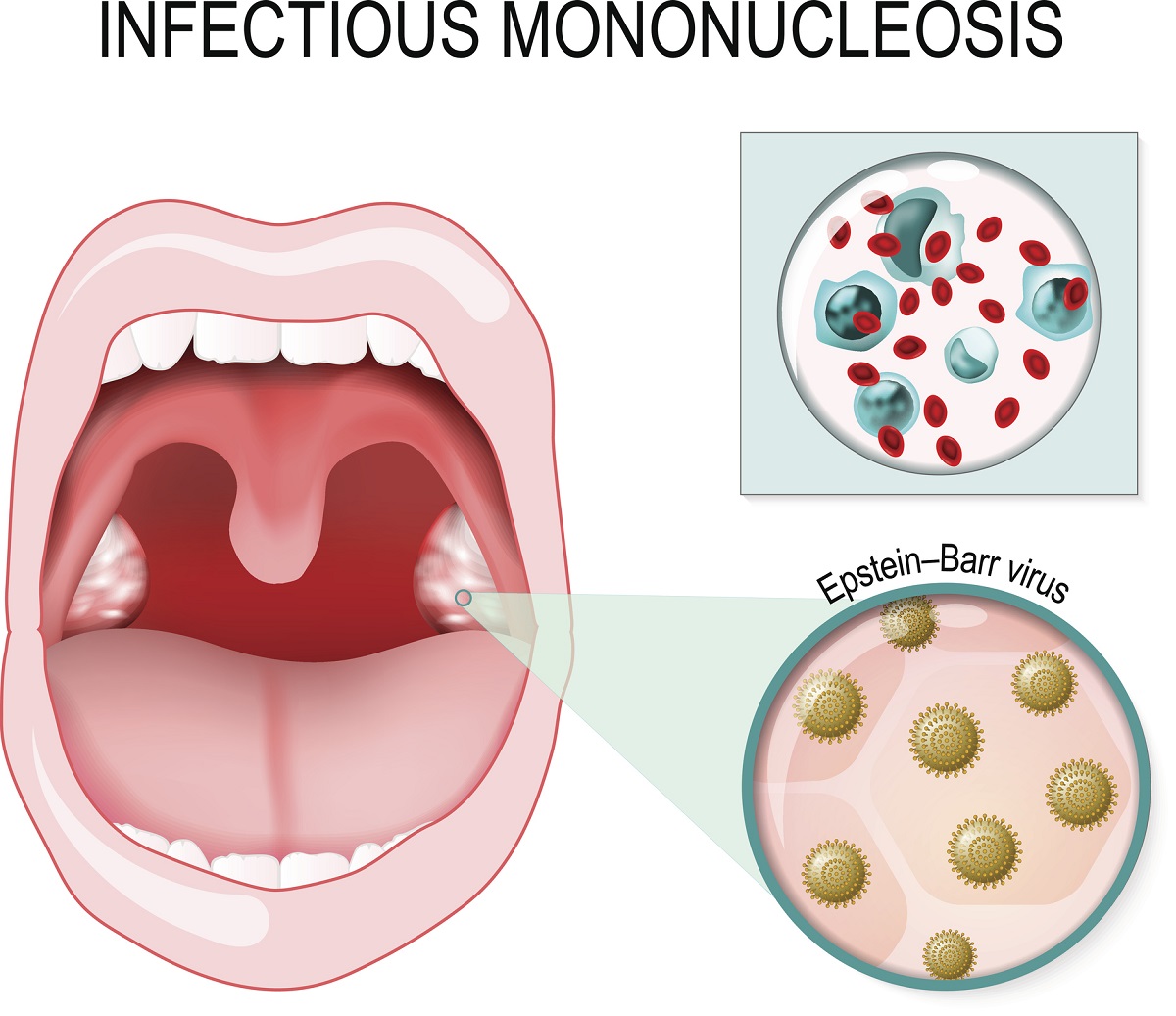 EBV - vírus mononukleózy a zápal hrdla