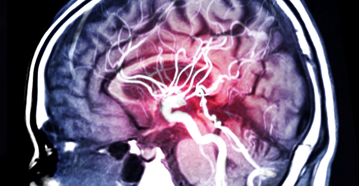 MRA – MR vyšetrenie mozgových ciev