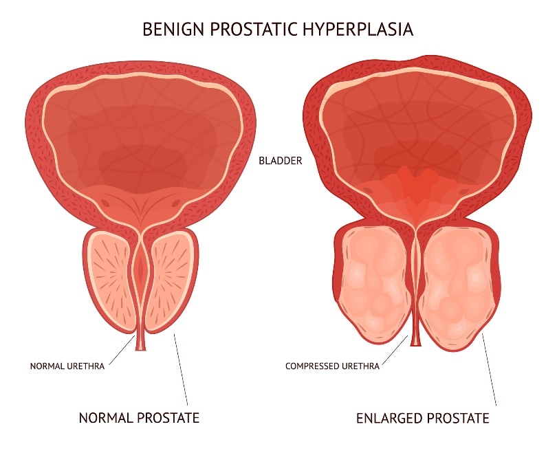 Benígne (nezhubné) zväčšenie prostaty. Bladder (močový mechúr), fyziologické a zväčšené tkanivo orgánu prostaty