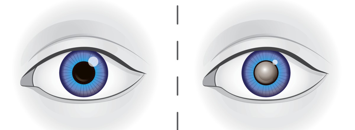 Naľavo: Oko so zdravou šošovkou. Napravo: oko so zakalenou šošovkou pri sivom zákale