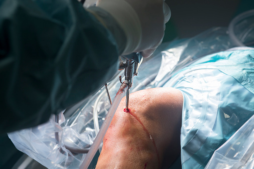 artroskopická operácia kolenného kĺbu
