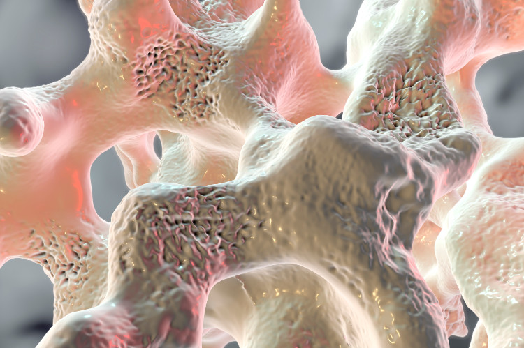 Osteoporóza u detí verzus osteogenesis imperfecta