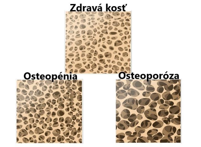 Grafické znázornenie prierezu kosti a jej štruktúry pri zdravej kosti, osteopénii a osteoporóze