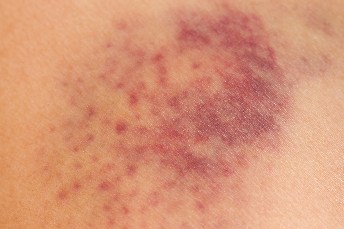 Petéchie, drobné krvné podliatiny vo veľkosti špendlíkovej hlavičky na koži ako prejav ochorenia alebo po poranení