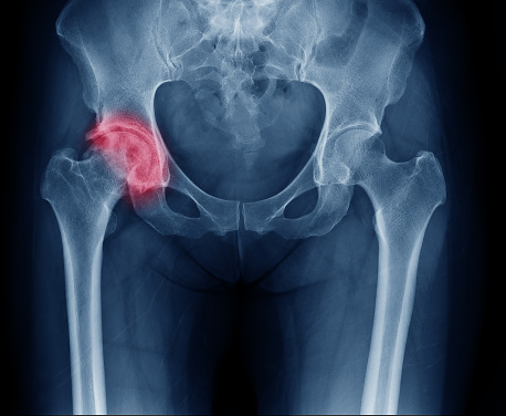 RTG snímok panvy, pravý bedrový kĺb postihnutý artrózou