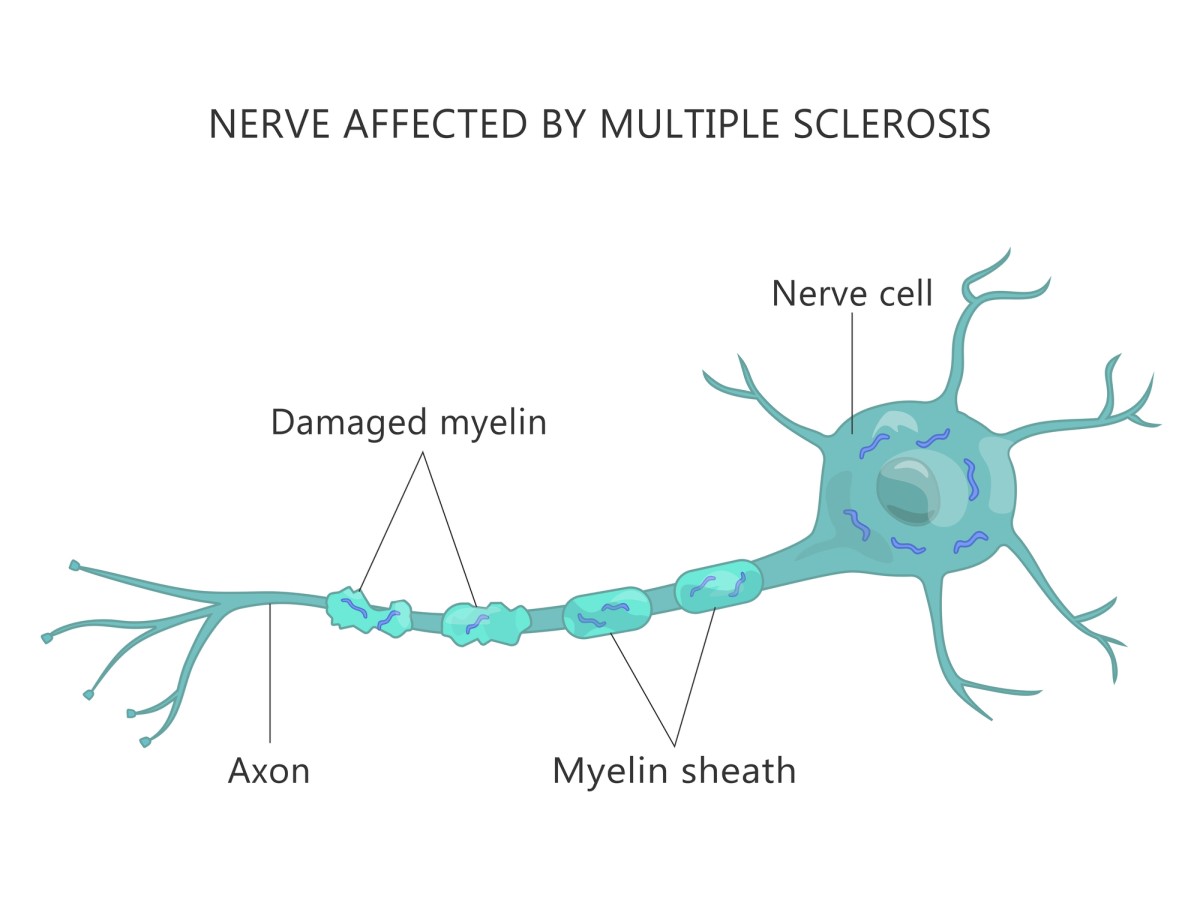 Anatomické zobrazenie - Nerv poškodený Sklerózou multiplex: demyelinizačný proces (poškodenie nervového obalu)