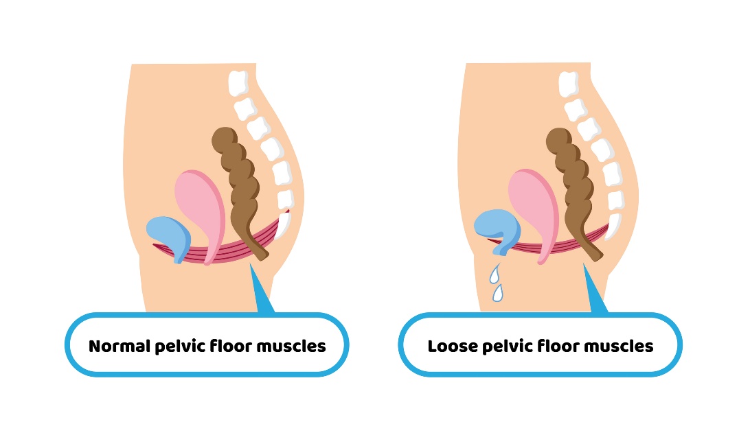 Fyziologický stav svalstva panvového dna a povolený stav svalstva panvového dna s dôsledkom inkontinencie