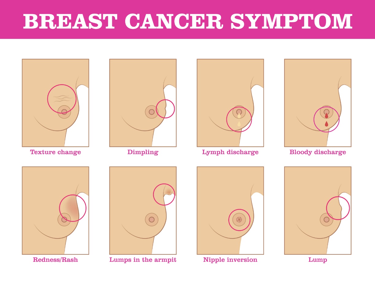 Symptómy rakoviny prsníka: zmena textúry prsníku, zmena farby a povrchu prsníku, výtok a vtiahnutie bradavky, lokalizácia hrčky