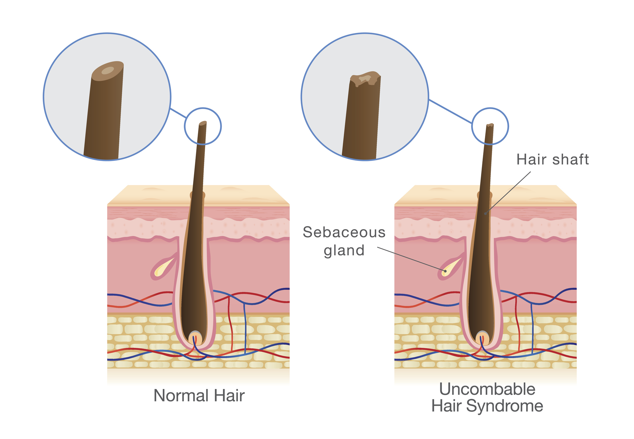 Porovnanie: normálny vlas napravo a vlas pri syndróme neučesateľných vlasov naľavo.
