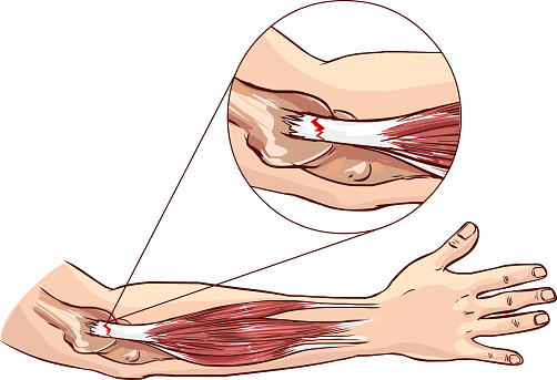anatomický náčrt hornej končatiny a úponu šľachy svalov predlaktia