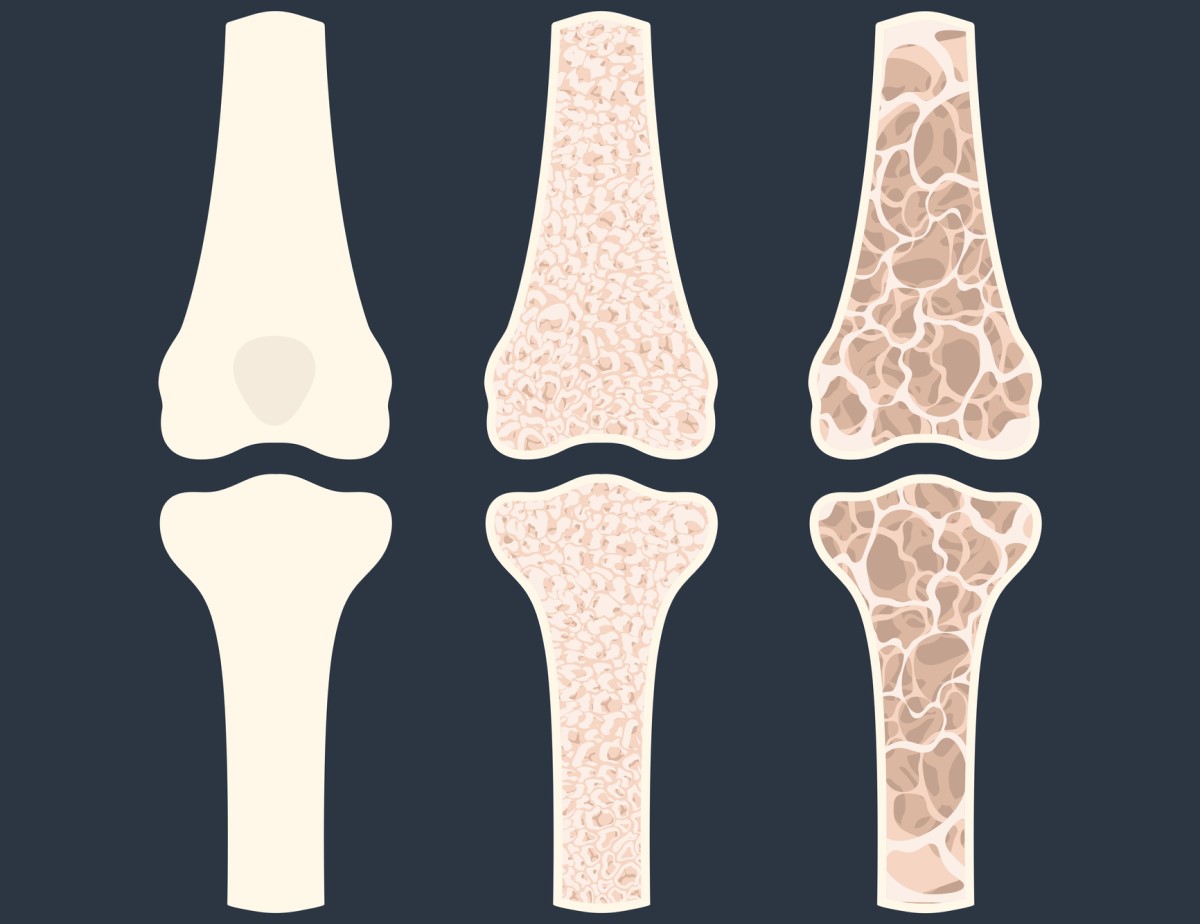 Animácia troch kostí, ktorá znázorňuje osteoporózu - rednutie kostí