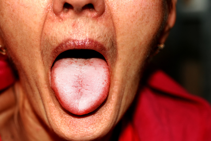 žena v červenom tričku vyplazuje jazyk postihnutý plesňou