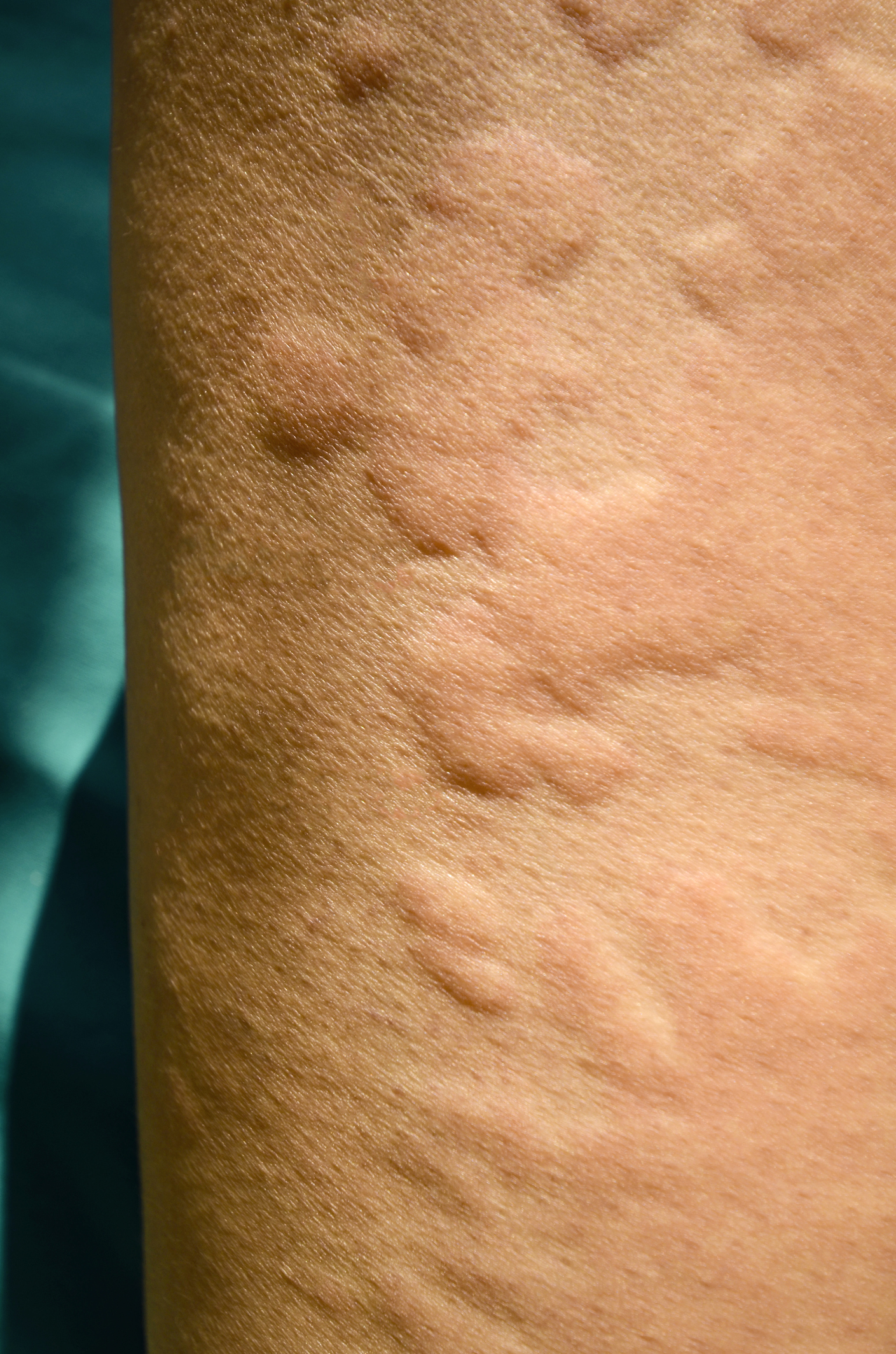žihľavka alergický ekzém - malé pupence vystupujú nad úroveň pokožky