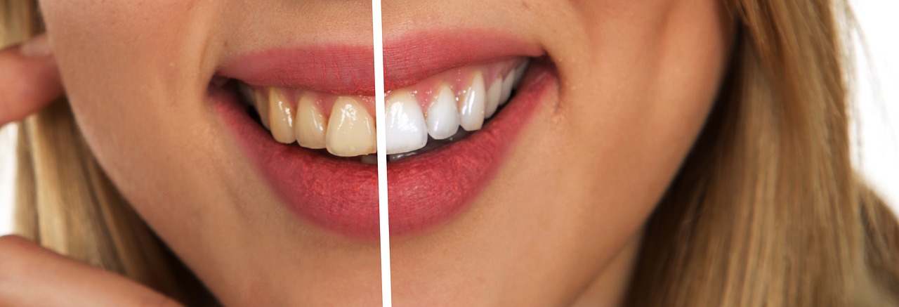 Žena, úsmev, zuby, porovnanie zažltnutých zubov a bielych zubov