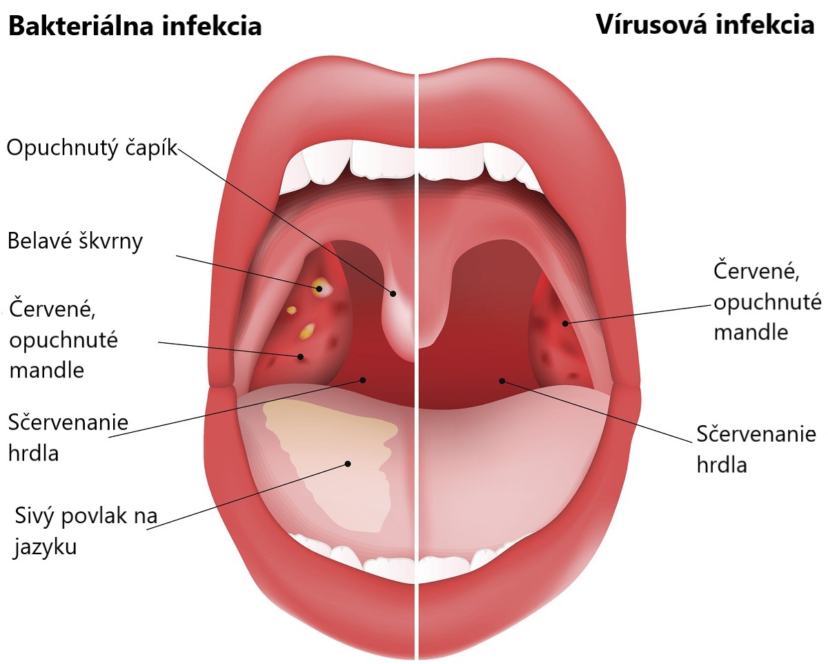 Rozdiel medzi vírusovou a bakteriálnou infekciou krčných mandlí