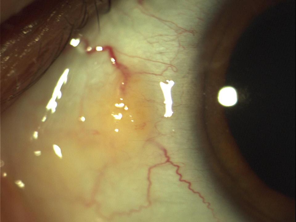 Oko s ochorením pinguecula