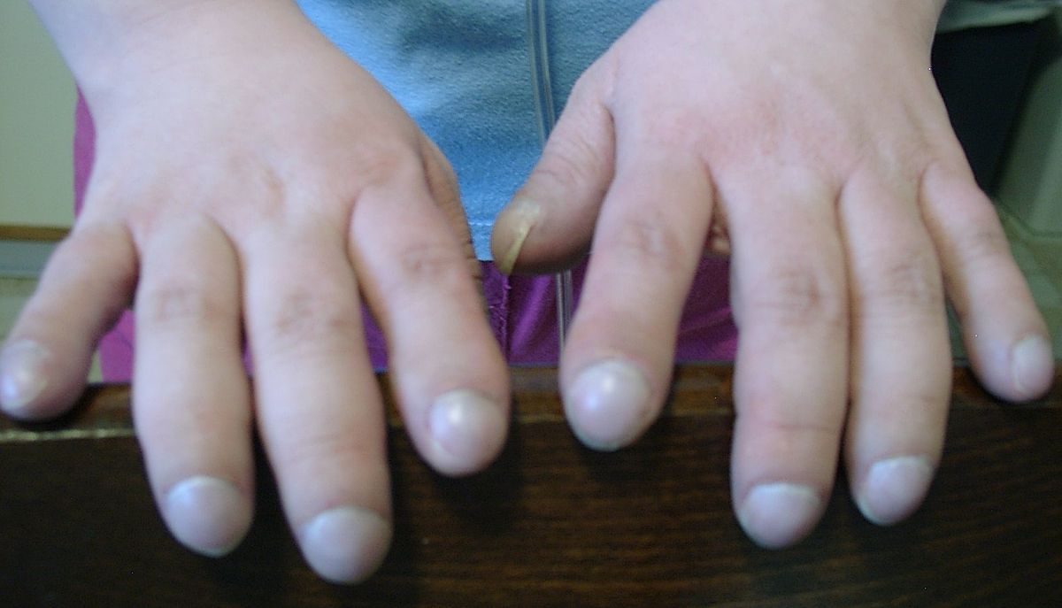 Paličkovité prsty ako príznak Eisenmengerovho syndrómu