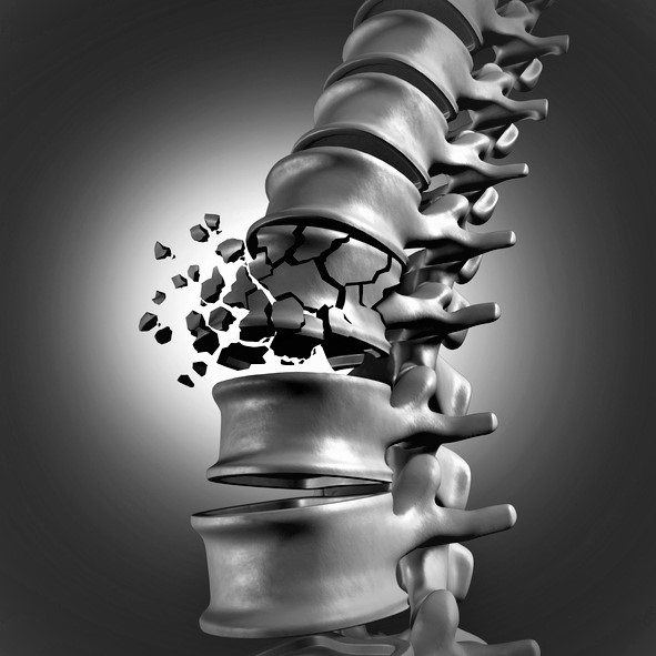 Zlomenina stavca chrbtice