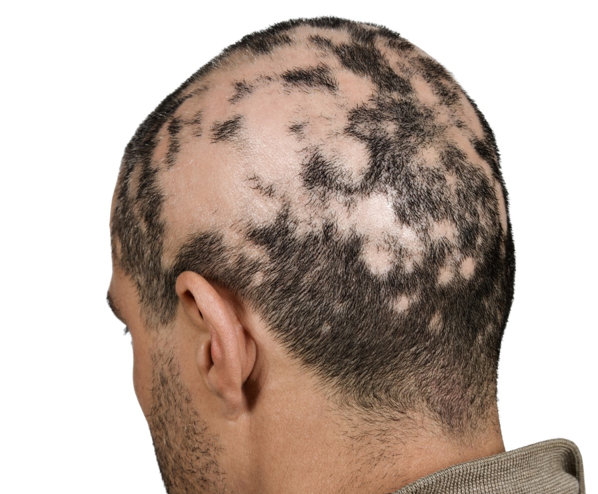 Mužská hlava - padanie vlasov - nadmerná strata vlasov vo forme ostrovčekov - alopécia areata