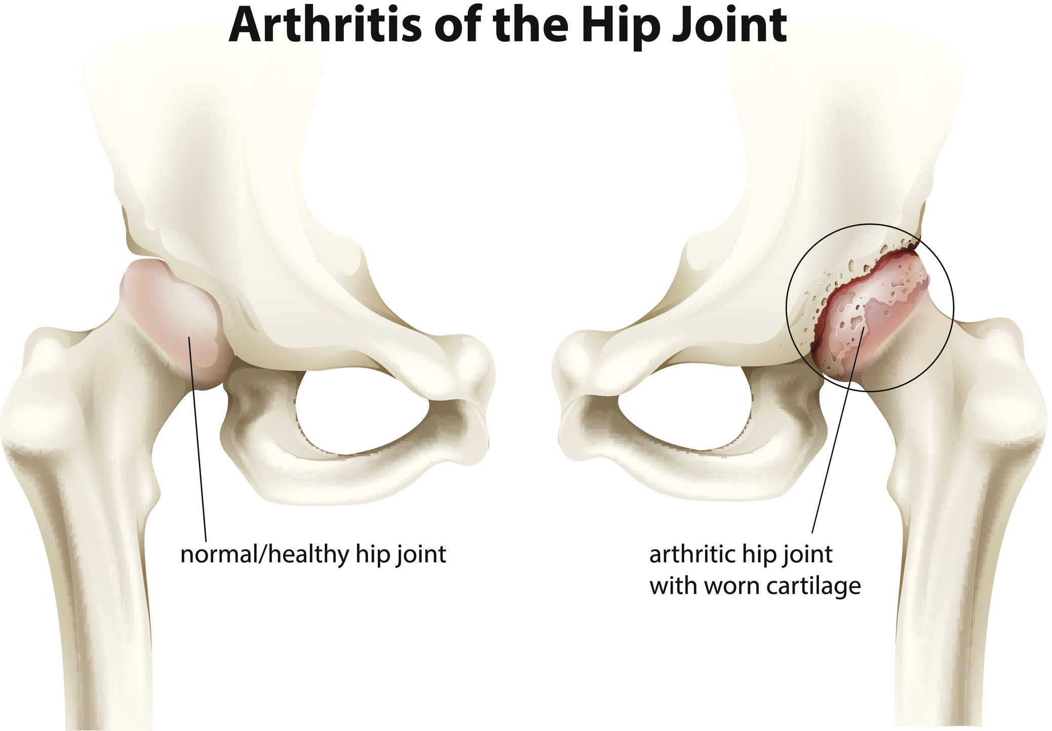 Artróza: stenčenie a poškodenie štruktúry chrupavky bedrového kĺbu