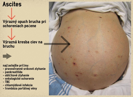 Ascites opuch brucha a popis