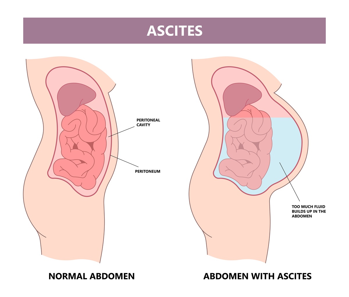 Ascites - nahromadenie tekutiny v brušnej dutin