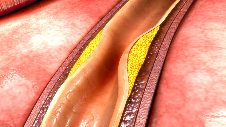 ateroskleróza, ukladanie tuku do cievnej steny