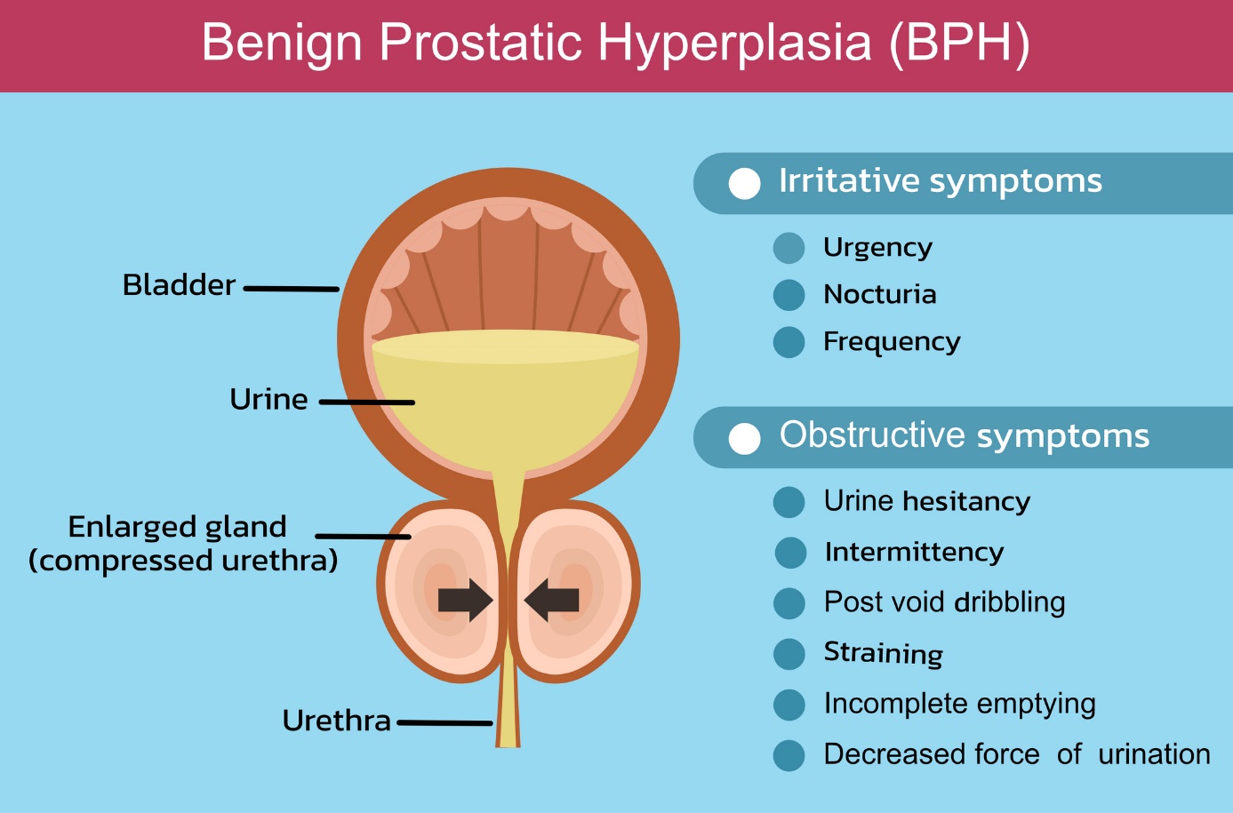 Benígna hyperplázia prostaty a opis v anglickom jazyku - močový mechúr, prostata, močová rúra stlačená pre hyperpláziu prostaty