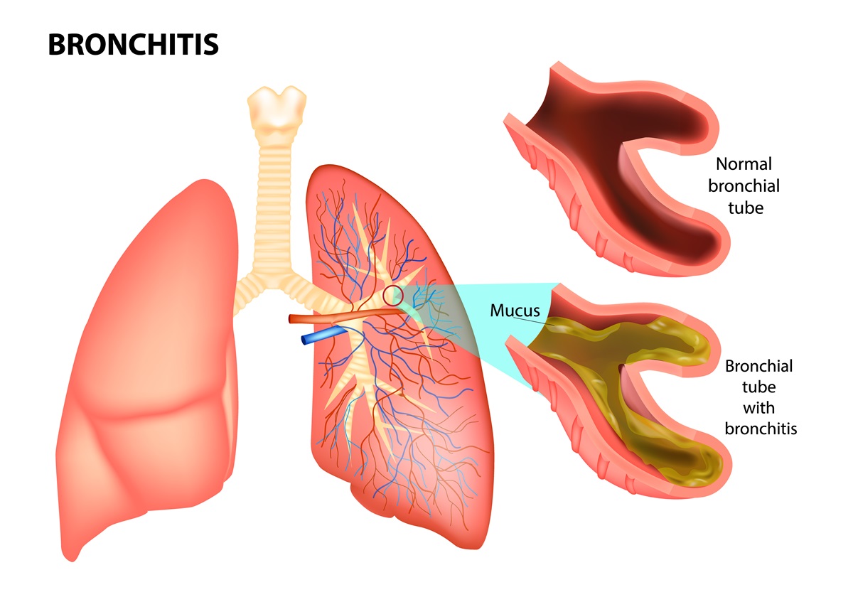 Bronchitída a zápal dolných dýchacích ciest