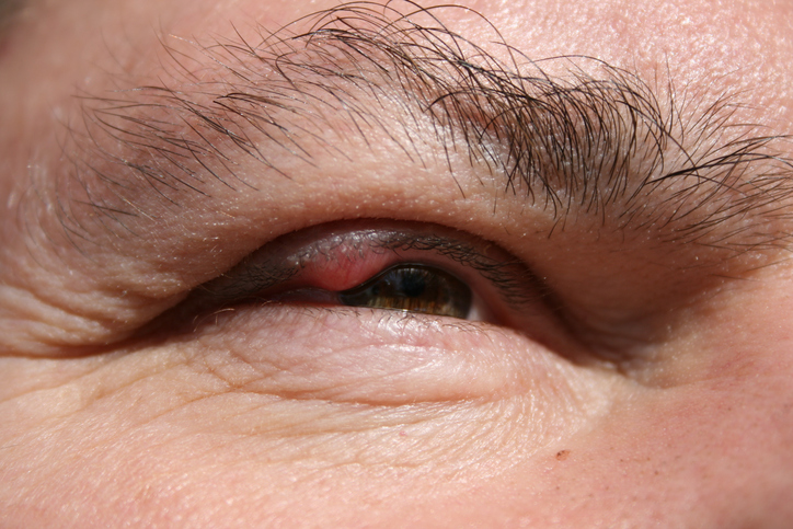 Muž má zapálené horné očné viečko pravého oka, zápal mazových žliaz, chalazion, teda vlčie zrno