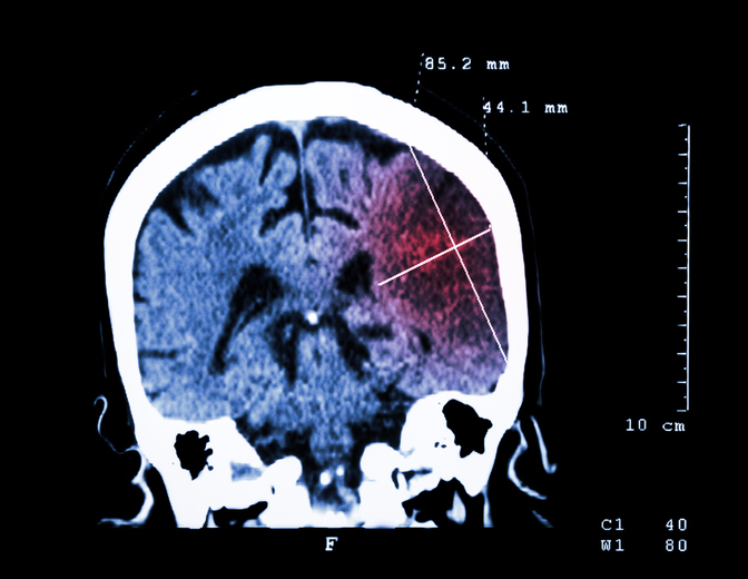 Poškodenie mozgu viditeľné na CT vyšetrení