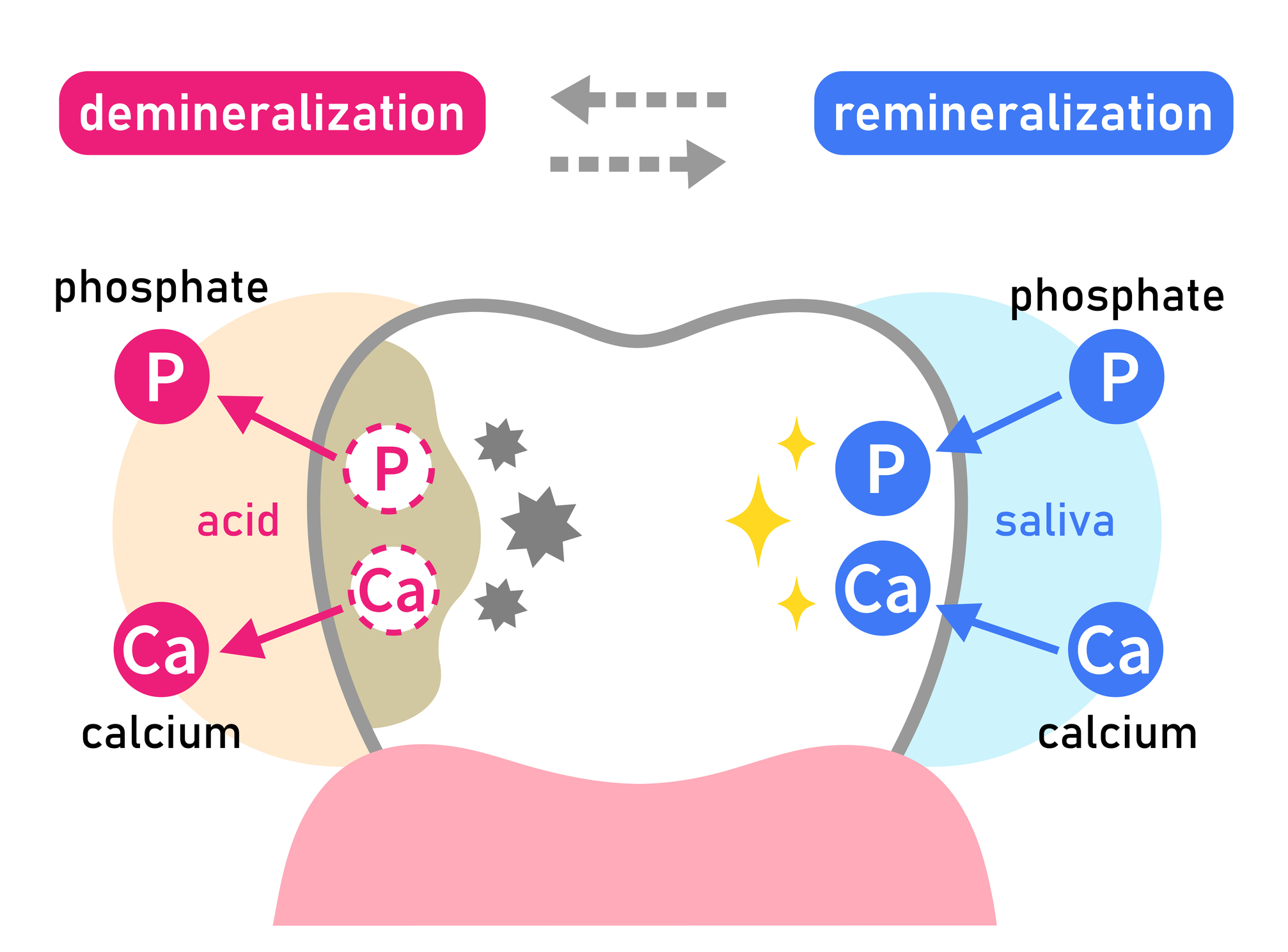 Demineralizácia (kyseliny a zníženie vápniku) a Remineralizácia (sliny a obnova vápnika) v zubnej sklovine
