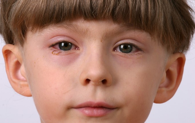 Dieťa má zapálené oko, začervenané a opuchnuté