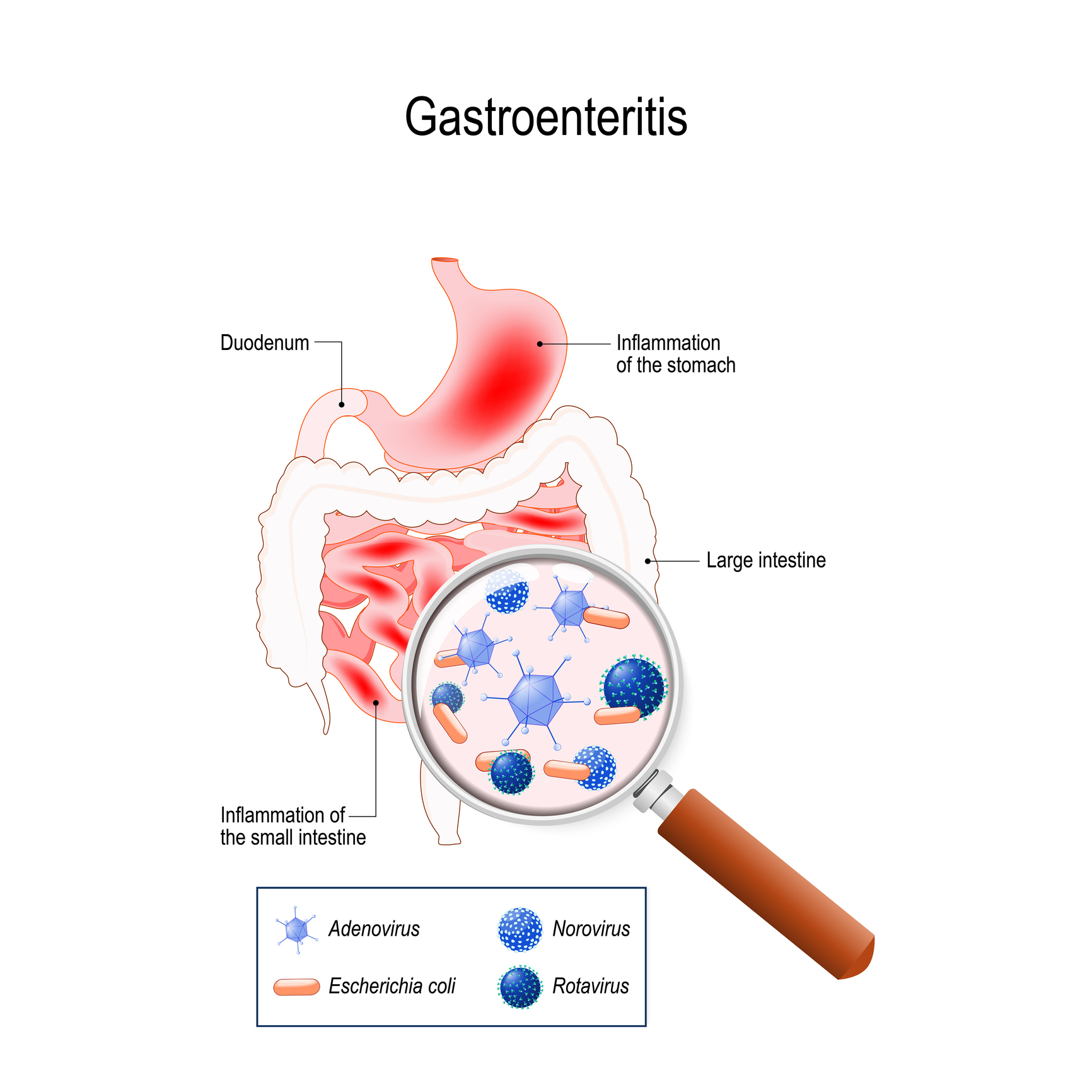 Gastroenteritída. Zápal žalúdka, dvanástnika a tenkého čreva