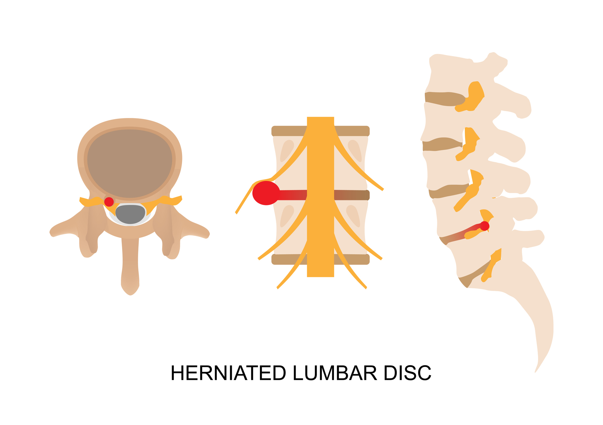 Hernia (posunutie - výrez) medzistavcovej platničky/disku v driekovej chrbtici a útlak príslušného nervu