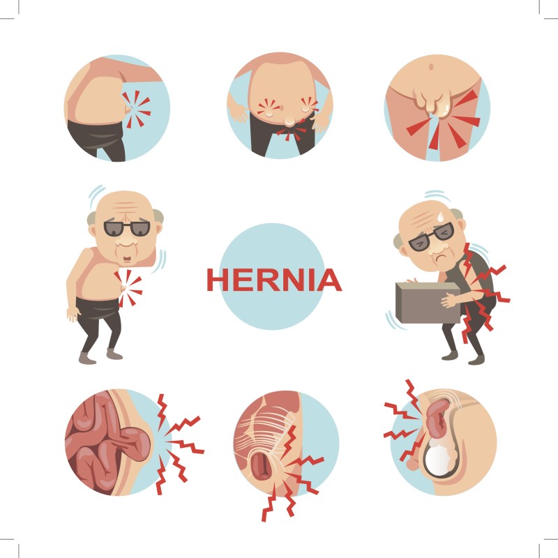 Hernia - model príznakov