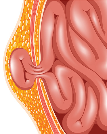 Hernia - jedna z častých komplikácii tohto problému Hernia