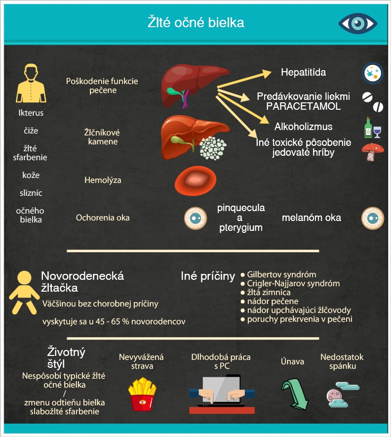 Zhrnutie najčastejších príčin Infografika znázorňuje najčastejšie príčiny žltých očných bielok
