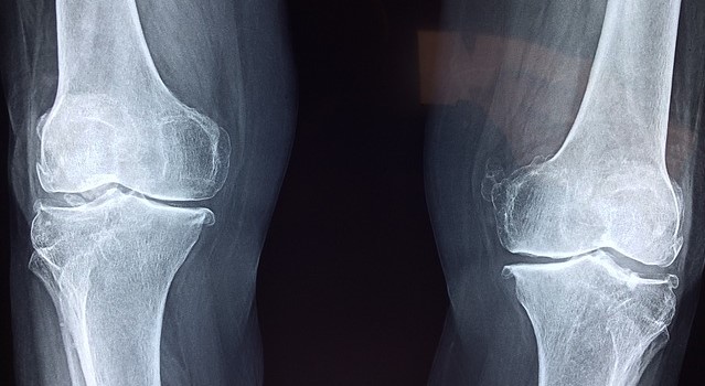 Rtg snímka kolenných kĺbov