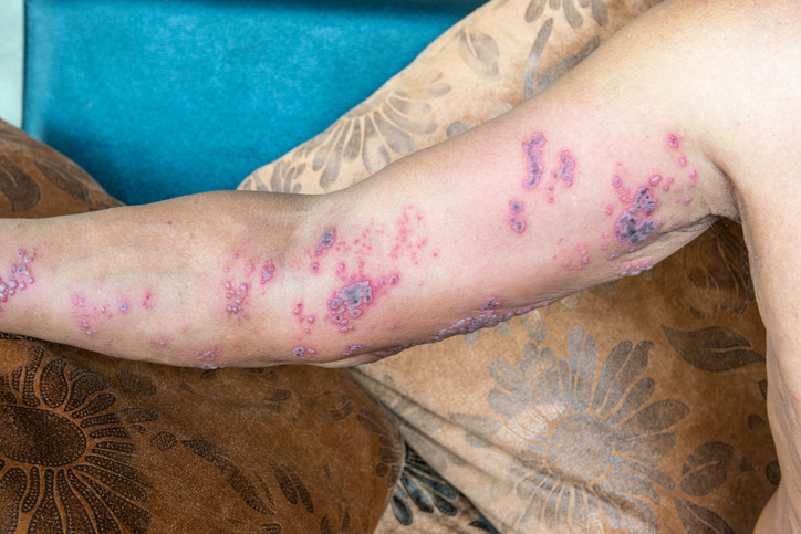 Kožná infekcia na pravej hornej končatine pri herpes zoster, prítomná je aj bolesť nervov v danej oblasti