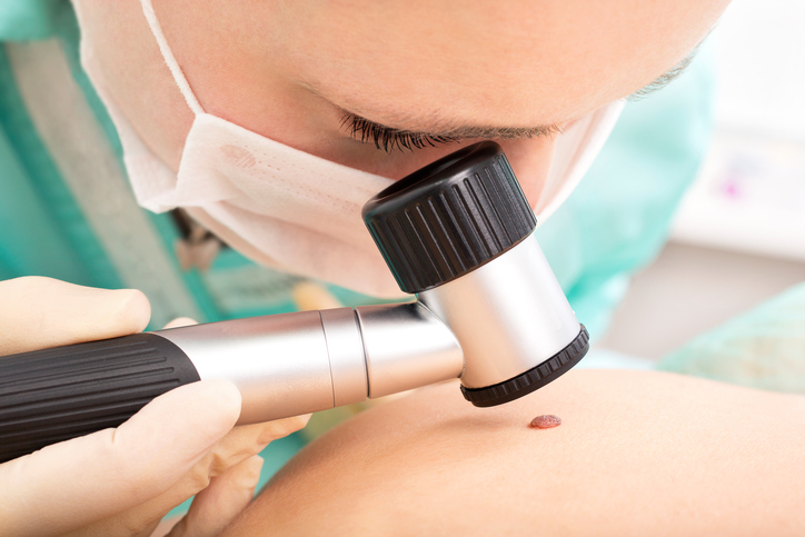 lekár vyšetruje kožné znamienko dermatoskopom