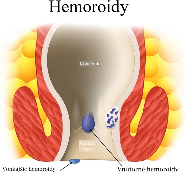Hemoroidy, vnútorné a vonakšie