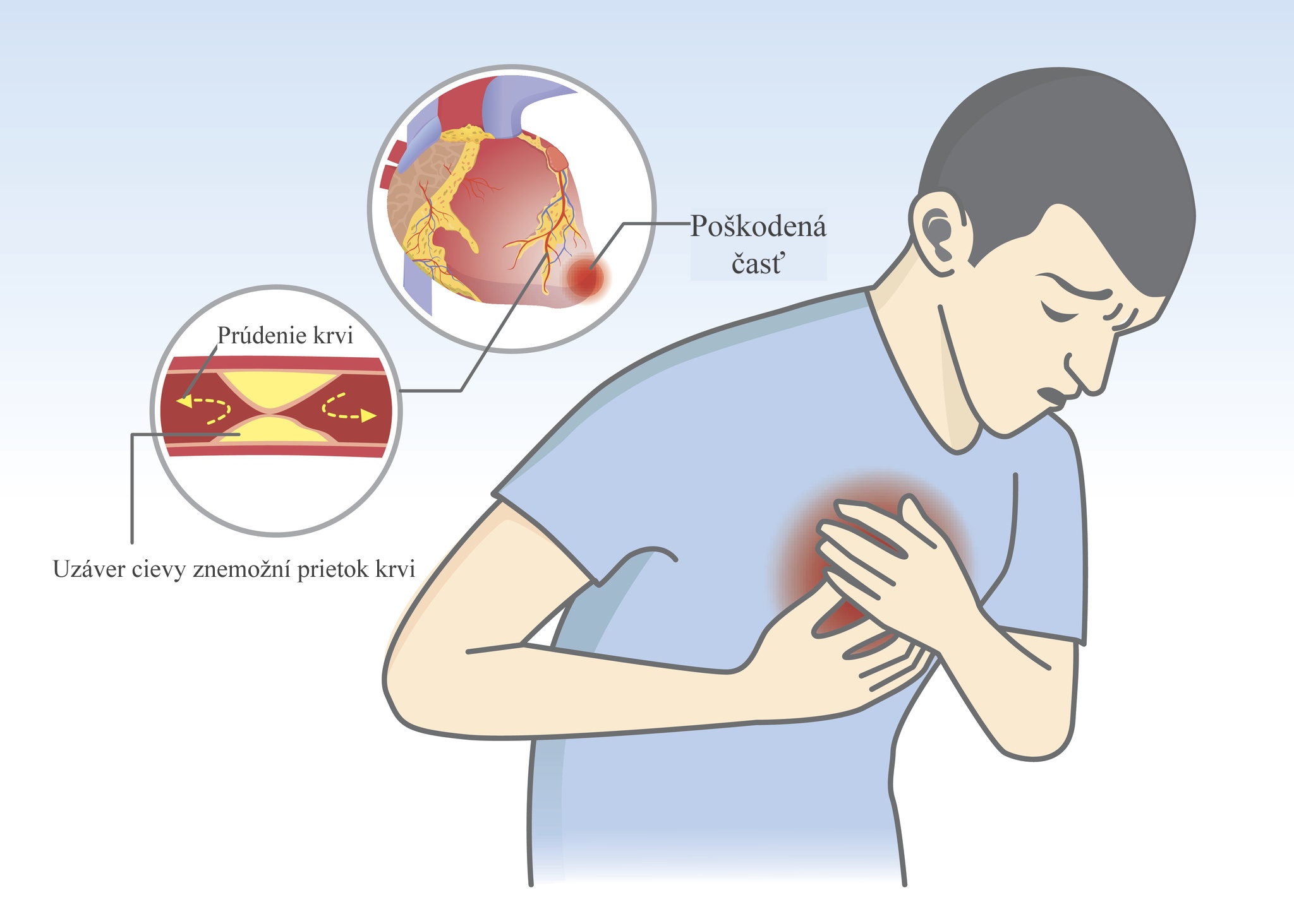 Model, mladý muž sa drží na hrudi, má bolesti na hrudníku, infarkt srdcového svalu, ukážka uzáveru, trombózy, aterosklerózy cievy