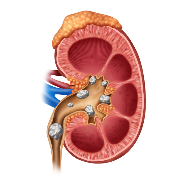 Model of a kidney, showing kidney stones