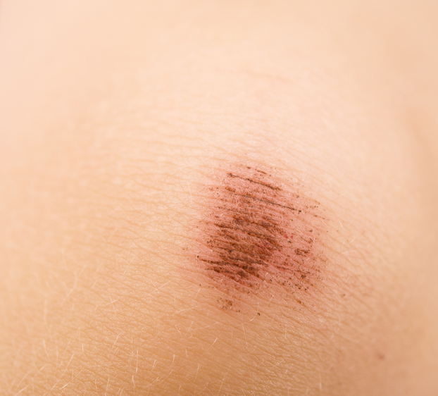Odrenina na koži, značí aj bolesť kože