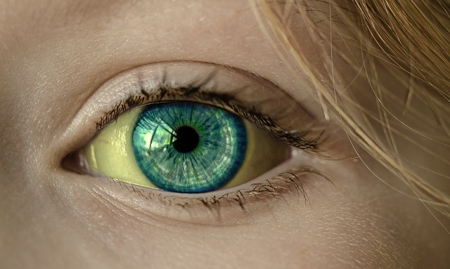 Žlté očné bielko pri ikteruse, teda žltačke výrez, detail oka